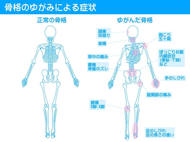 骨盤のゆがみによる症状