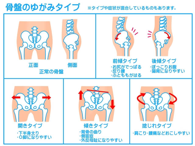 骨盤のゆがみタイプ