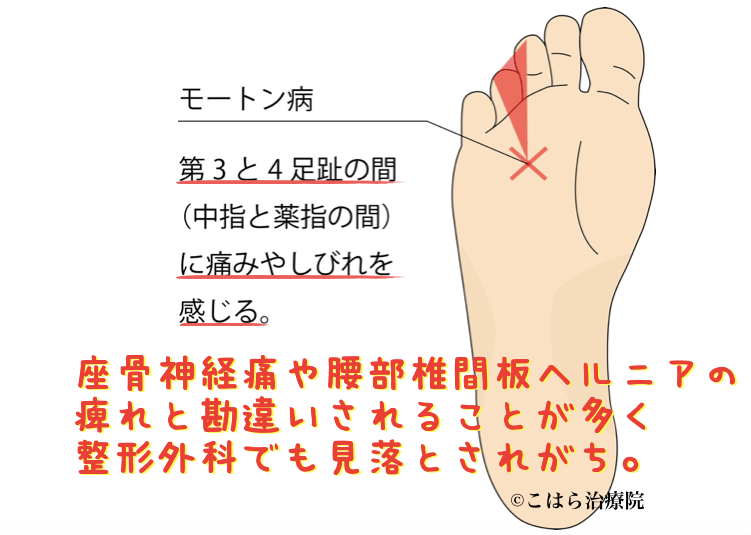 モートン病説明