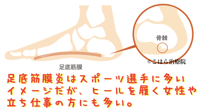 足底筋膜炎はスポーツ選手に多いイメージだが、ヒールを履く女性や立ち仕事の方にも多い。